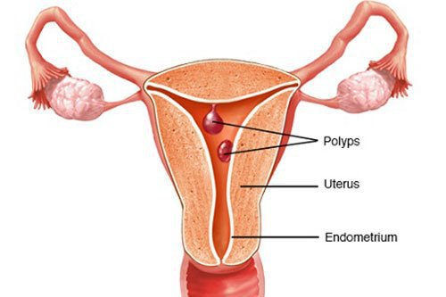 Polyp cổ tử cung: nguyên nhân, dấu hiệu, cách điều trị